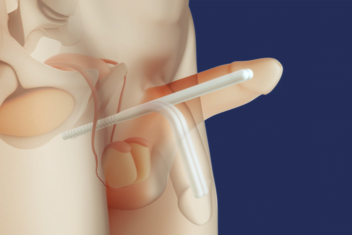 Sertleşme Bozukluğu Cerrahisi